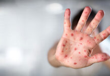 Rujeola, o boală fatală pentru 1/1000 de români